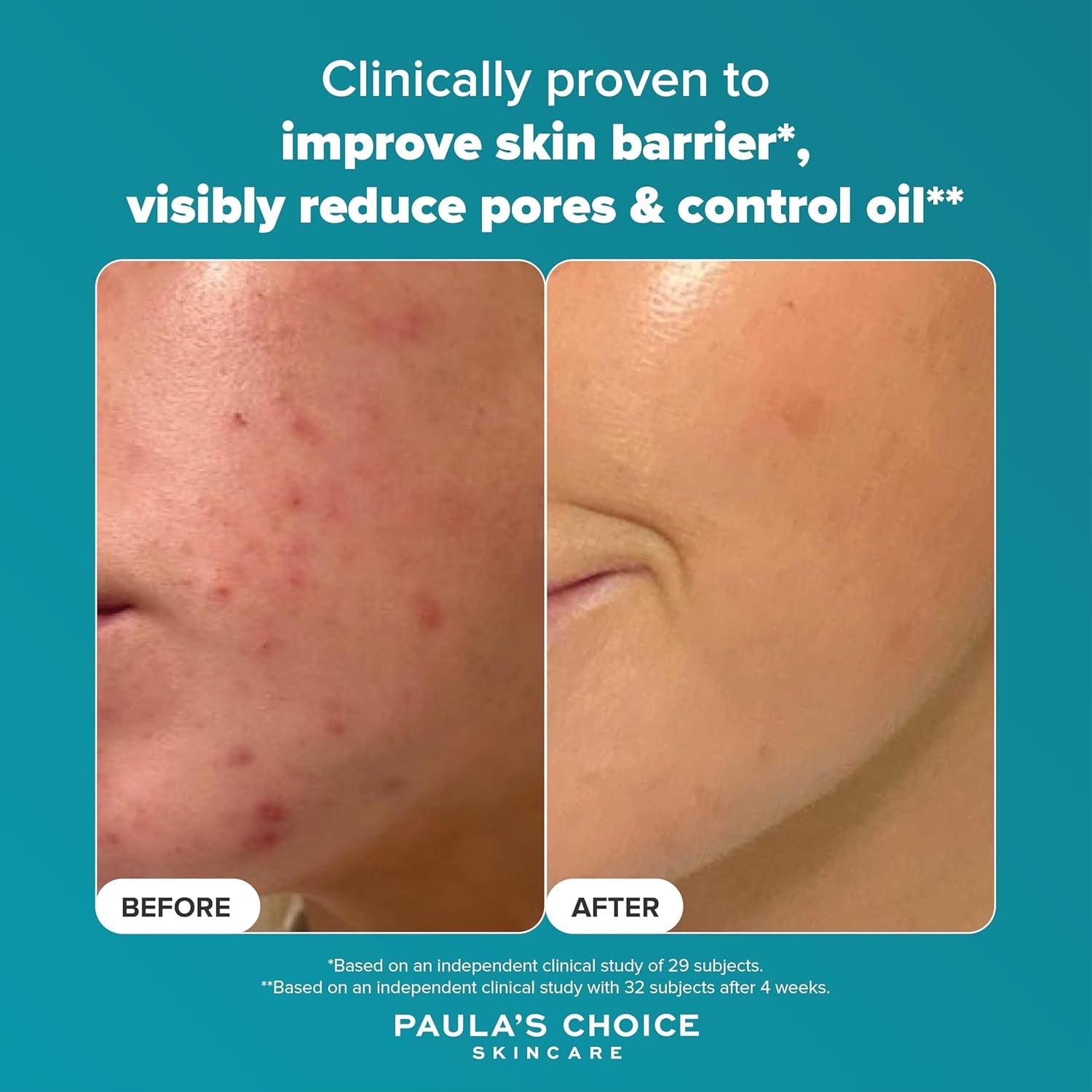 SKIN PERFECTING 2% BHA Esfoliante Liquido - Peeling Viso Con Acido Salicilico - Combatte Imperfezioni, Punti Neri & Brufoli - Ridurre I Pori - Pelli Miste O Grasse - 118 Ml